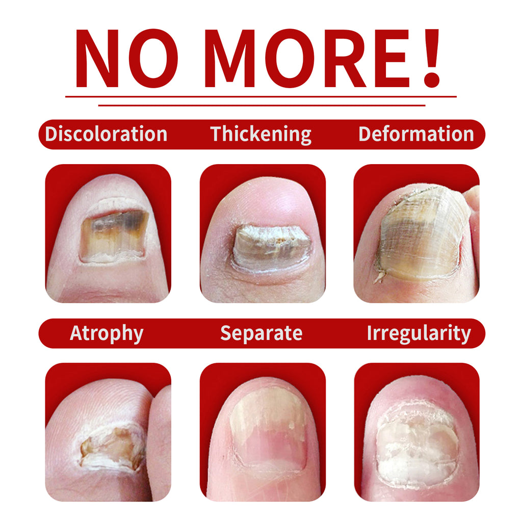 Jaysuing Ginger Nail Care Solution Gentle Care for Hands and Feet, Soft Nails, Smooth Nail Surface, Moisturizing and Brightening Nail Liquid