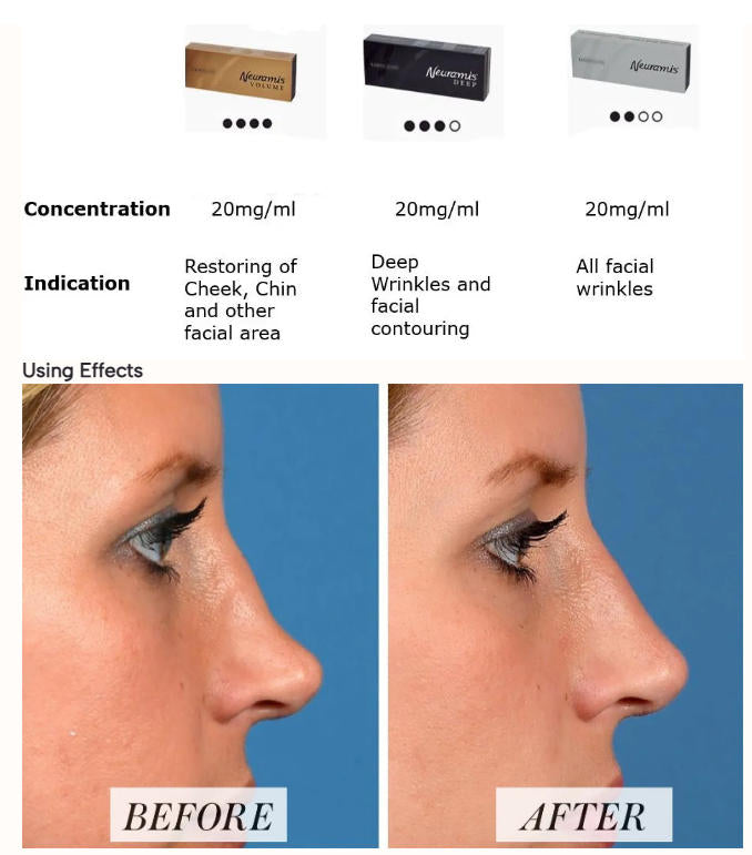 Korea Neuramis Deep Volume Dermal Filler 1ml for Face Lift